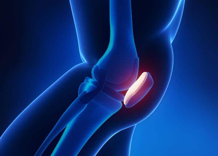 Knee Cap Fracture and Its Types