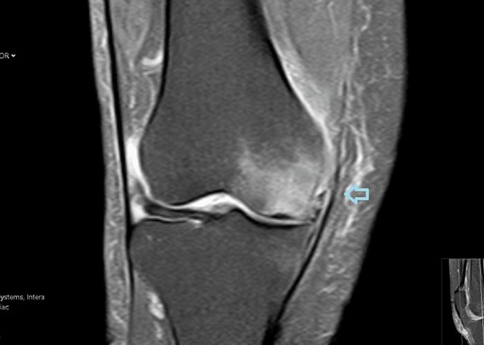 Subchondral Insufficiency Fracture of the Knee