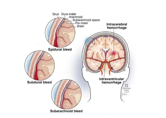 Spinal Epidural Hematoma Symptoms